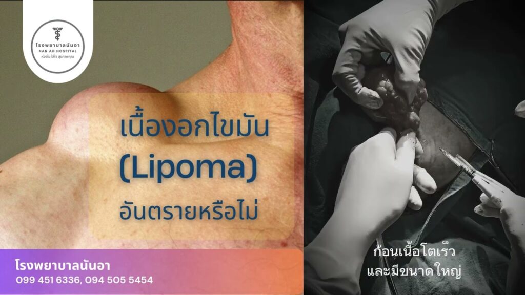 ก้อนเนื้อไขมัน หรือ เนื้องอกไขมัน (lipoma)